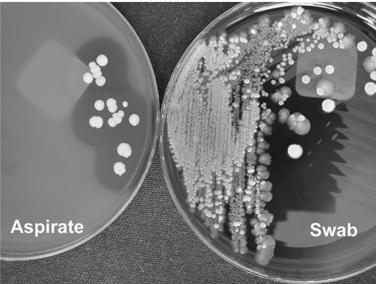 - Comparison of aspirated pus and swab culture from an infected joint site. Image source: Koneman’s Color Atlas and Textbook of Diagnostic Microbiology