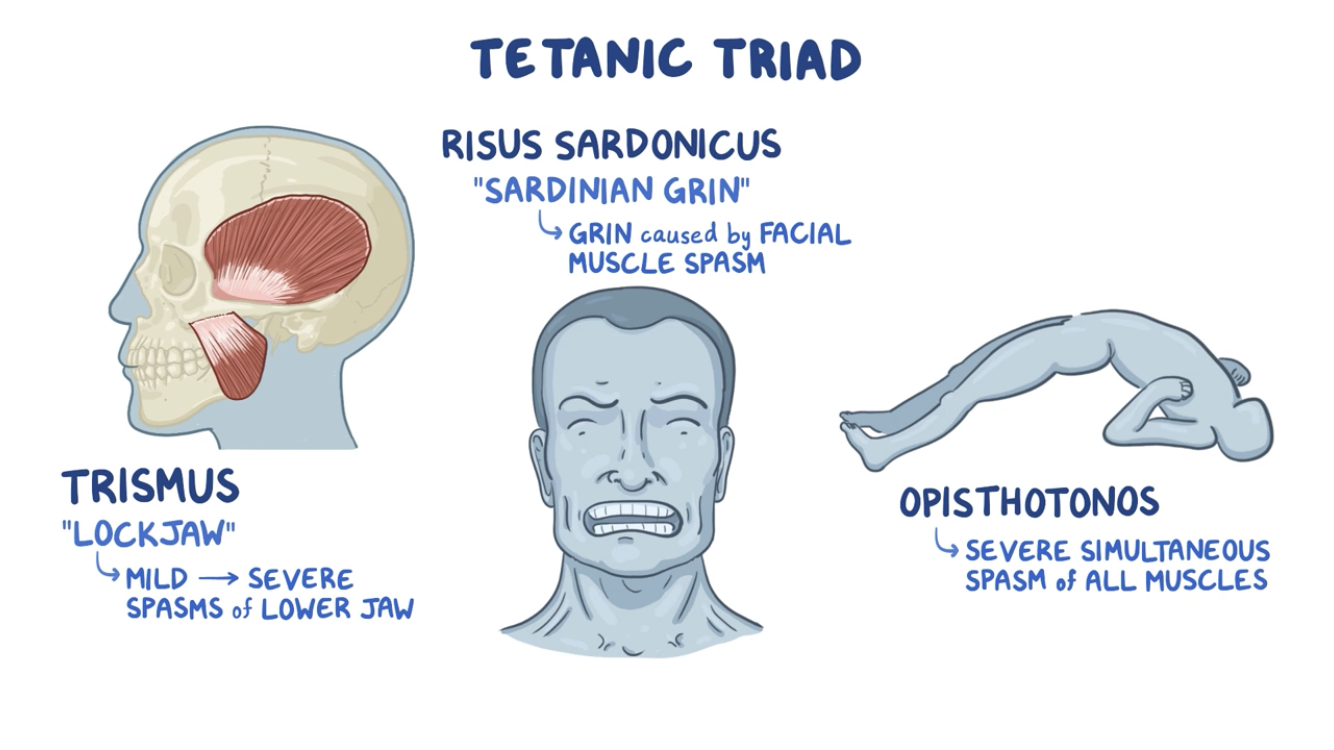 Clinical Manifestations and Complications of Tetanus - Clinical Manifestations and Complications of Tetanus(Image source: osmosis.org)