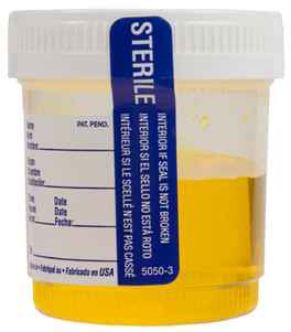 Urine collection bottle (urinary tract infection)