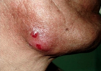 Actinomyces infection