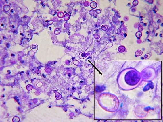 - Blastomyces dermatitidisin Lung Fine Needle Aspiration Assay stained with PAS.The insert shows large broad-based budding as a daughter cell is being produced.(Image source:http://thunderhouse4-yuri.blogspot.com/)