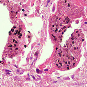 - Cysts ofP. jiroveciiin lung tissue, stained with methenamine silver and hematoxylin and eosin (H&E).  (Image source:CDC)