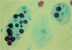 E.histolytica with ingested RBCs - E.histolyticawith ingested RBCs