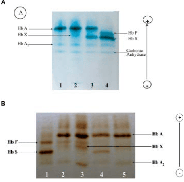 Electrophoretic study. - Electrophoretic study. A) Cellulose acetate electrophoresis at alkaline pH. Lane 1: normal adult control; lane 2: proband; lane 3: sickle cell trait control; lane 4: homozygous sickle cell. B) Isoelectric focusing on polyacrylamide gel. Lane 1: homozygous sickle cell; lane 2: β-thal trait and Hb X lane 3: proband; lane 4: sickle cell trait control; lane 5: normal adult control. (5)