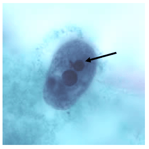 - Trophozoite ofEntamoeba histolyticawith ingested RBC