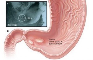 Gastric ulcer - Gastric ulcer