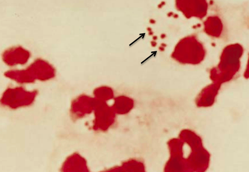 Gram stain of N. meningitidis in CSF - Gram stain ofN. meningitidisin CSF