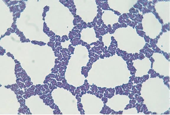 Gram stain of Staphyloccus