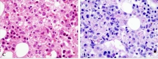 Histoplasma capsulatum in bone marrow biopsy C.  - Histoplasma capsulatumin bone marrow biopsyC.H & E stain 1000 D.PAS Stain 1000 Source: ncbi.nlm.nih.gov