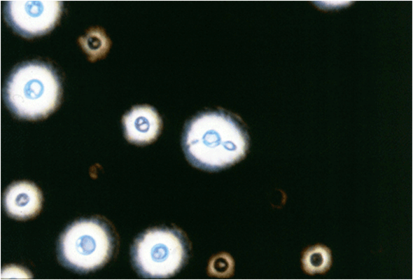 - India ink preparation of CSF sample
