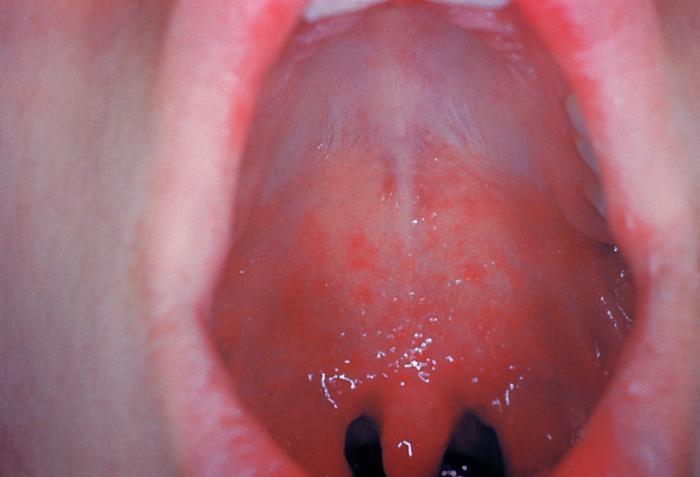 Kopliks spot - Koplik’s spot is the major diagnostic criterion for Measles Source: CDC