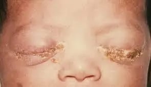 Opthalmia neonatorum - Opthalmia neonatorum
