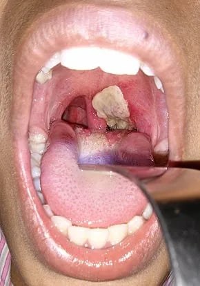 Pseudomembrane in Corynebacterium diphtheriae - Pseudomembrane seen in a diphtheria case