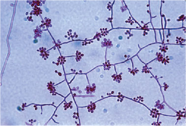 Mold phase of S. schenckii mounted on Parker-Quink stain showing thin septated hyphae with right-angled conidiophores and ovoid-shaped conidia in a “rosette”-like arrangement. Reproduced with permission from A/Prof. David Ellis, University of Adelaide. - Mold phase of S. schenckii mounted on Parker-Quink stain showing thin septated hyphae with right-angled conidiophores and ovoid-shaped conidia in a “rosette”-like arrangement. Reproduced with permission from A/Prof. David Ellis, University of Adelaide.