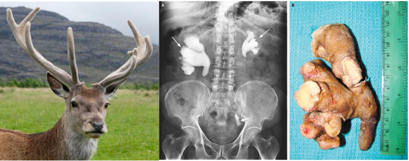 - Stag (male deer) and Staghorn calculi (source)