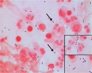 - Streptococcus pnuemoniae: Gram positive diplococci