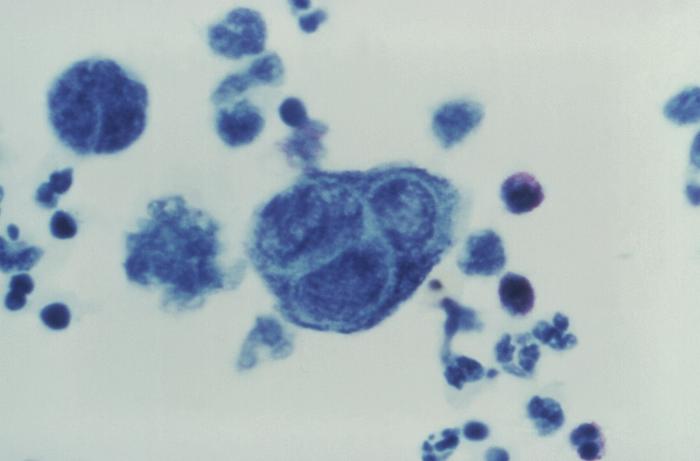 Tzanck cells (multinucleated giant cells in VZV lesions) - Tzanck test: Note the presence of a multinucleated giant cell (Tzanck cell) in the center. (Image source: CDC PHIL)