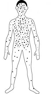 - Distribution of chickenpox rashes