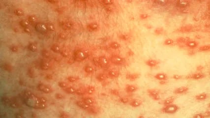 - Vesicular rashes in chickenpox (Image source: CDC/PHIL)Three types of lesions are most often seen in varicella-zoster infections;maculopapular lesions (lesions with a raised red bump), vesicular lesions (blister-like or fluid-filled lesions), and scabbed or crusted lesions.