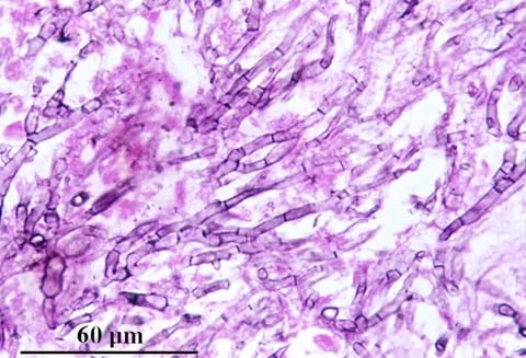 - Dichotomously branched, septate hyphae of Aspergillus fumigatus in lung tissue section after Methenamine silver stain(Source)