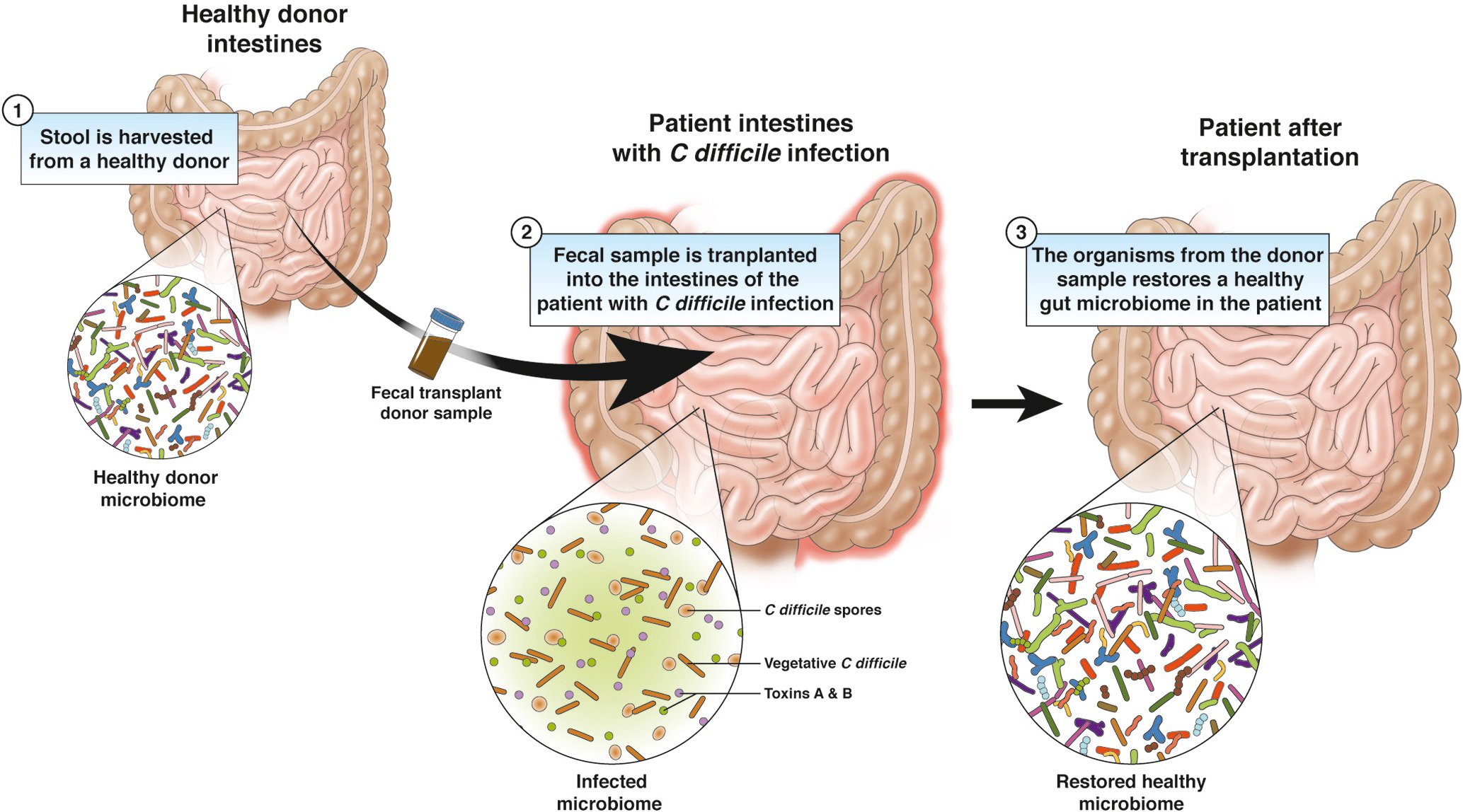 Fecal Transplant