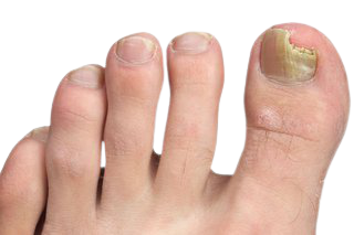 Infected nails - Infected nail