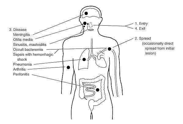 Types of disease caused by Streptococcus pneumoniae - Types of disease caused byStreptococcus pneumoniae