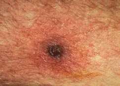- Eschar at site of chigger bite(Imagesource)