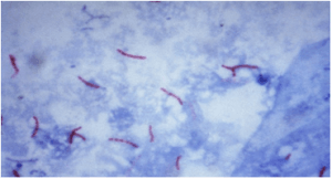 Acid fast bacillus - Acid-fast bacillus (AFB) in Z.N smear