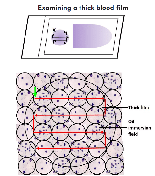 - Examining the thick blood films