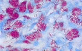 M. leprae in stained smear  - M. lepraein stained smear
