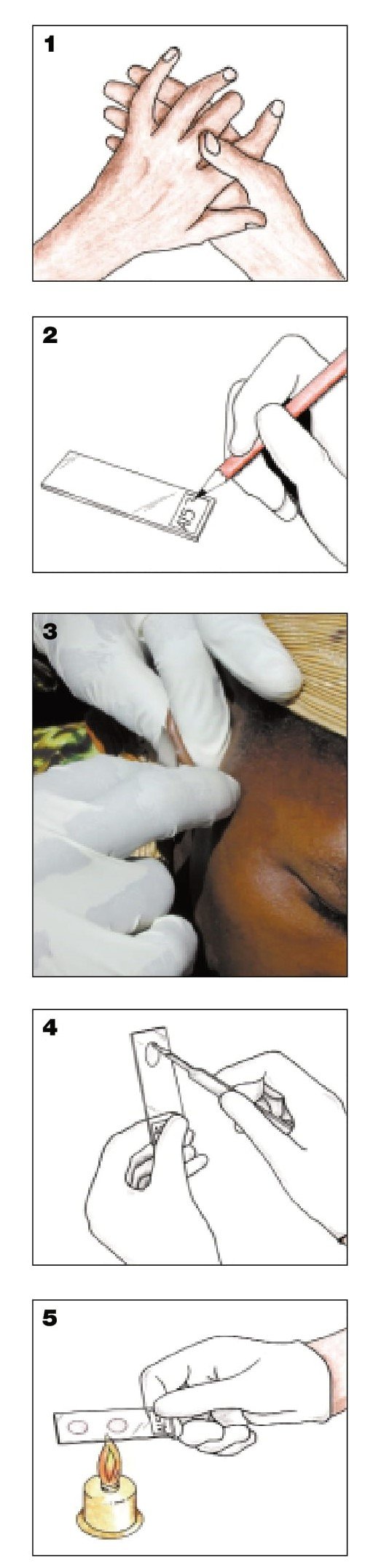 Taking a skin smear