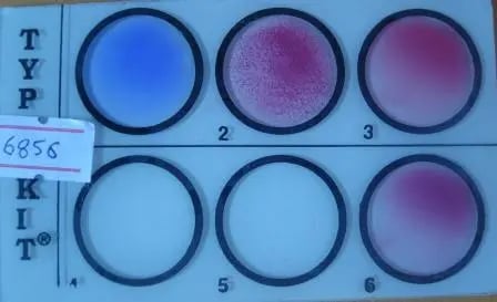 Widal Test: Sample showing H positive in screening test - Widal Test: Sample showing H positive in screening test