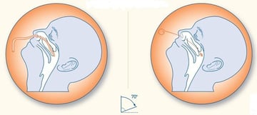 Nasopharyngeal Swab Collection: Procedure, Depth, and Common Mistakes