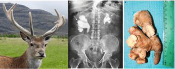 Proteus: Swarming, Urease, and How It Causes UTIs and Kidney Stones