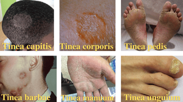 Types of Tinea (Ringworm): Sites, Causes, and Clinical Features