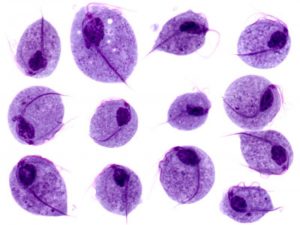 Trichomonas vaginalis: Clinical Features, Lab Diagnosis, and Differentiation from Bacterial Vaginosis