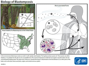 Blastomyces dermatitidis: Pathogenesis, Lab Diagnosis