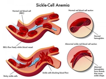 Sickle Cell Anemia and Malaria: Protection, Risk, and the Evolutionary Paradox