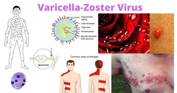 Varicella-Zoster Virus: How One Virus Causes Two Diseases Decades Apart
