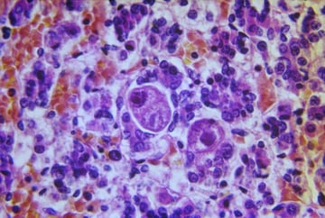 Cytomegalovirus (CMV): Structure, Congenital Disease, and Laboratory Diagnosis