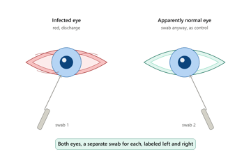 Eye Specimens: Collection and Transport (Conjunctival Swab, Corneal Scraping)