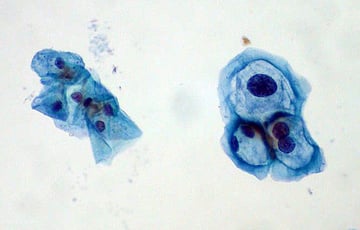 Human Papillomavirus (HPV): Warts, Cervical Cancer, and the Vaccine