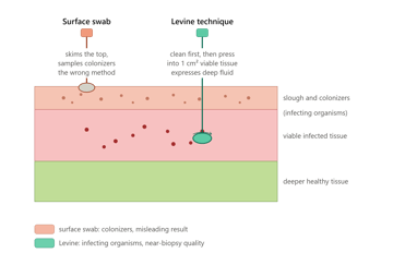 Wound Swab: Collection, the Levine Technique, and When Not to Swab