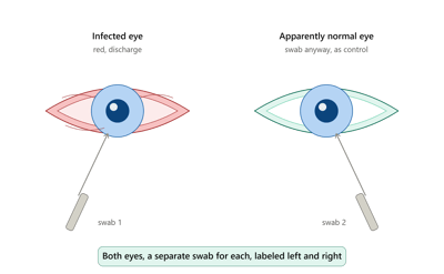 Eye Specimens: Collection and Transport (Conjunctival Swab, Corneal Scraping)