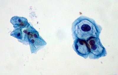 Human Papillomavirus (HPV): Warts, Cervical Cancer, and the Vaccine