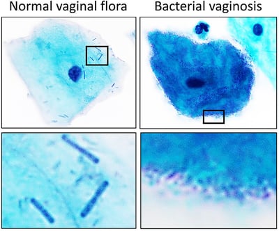 Normal Vaginal Flora: Lactobacilli, Acidic pH, and How the Vagina Protects Itself
