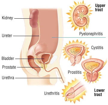 Urine Culture: Sample Collection, Transport and Lab Diagnosis 