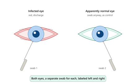 Eye Specimens: Collection and Transport (Conjunctival Swab, Corneal Scraping)
