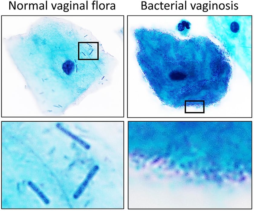 Normal Vaginal Flora: Lactobacilli, Acidic pH, and How the Vagina Protects Itself